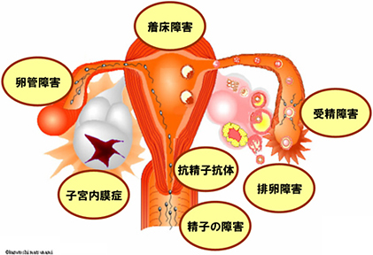 不妊症の原因