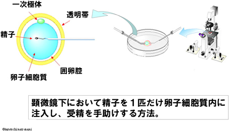 ICSIの実際