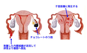 子宮 内 膜 症 性行為