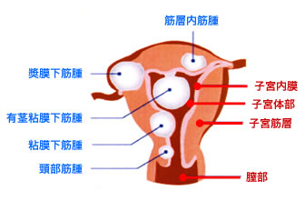 子宮筋腫